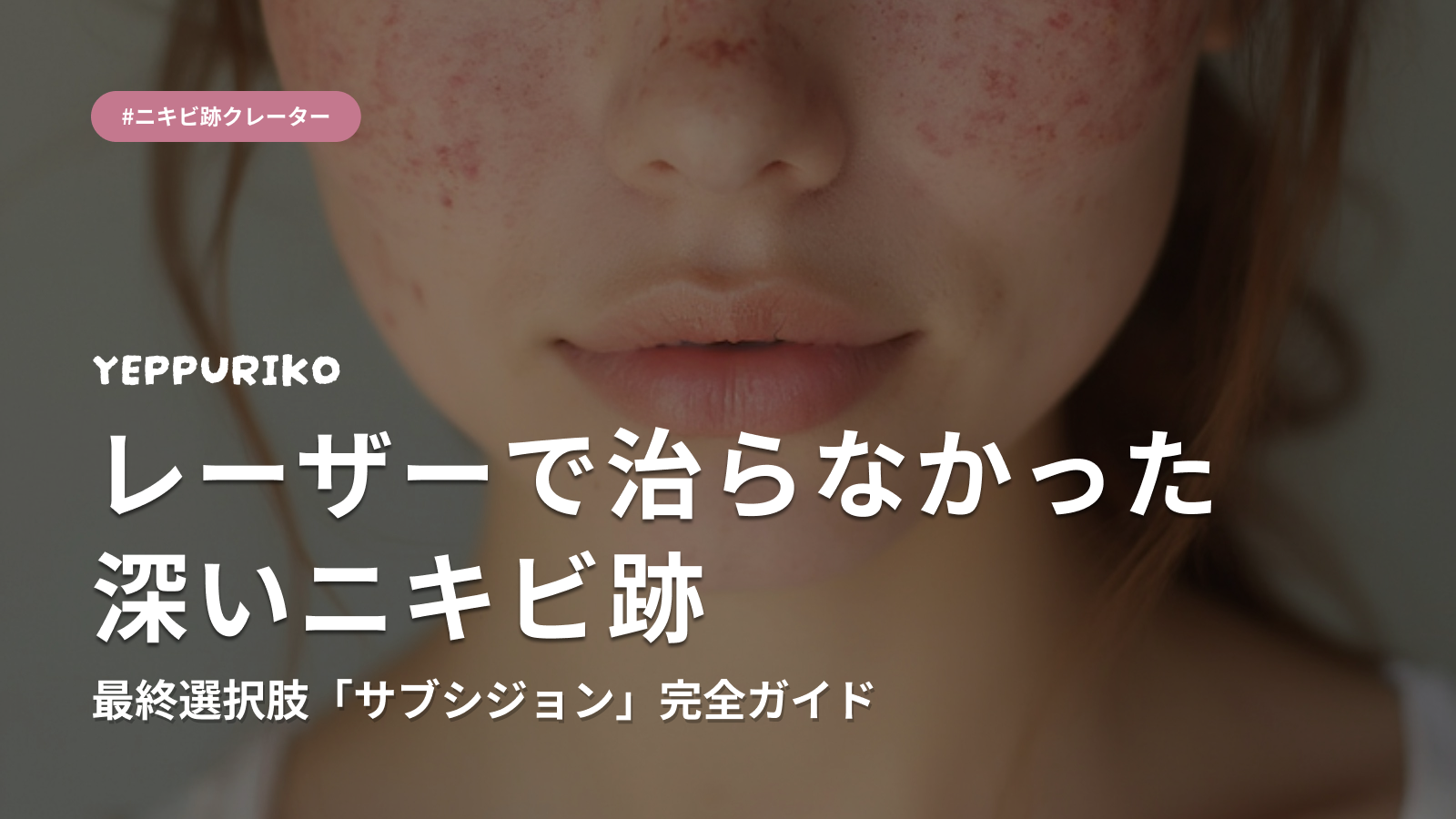💡 サブシジョンとは?仕組みをかんたんに解説