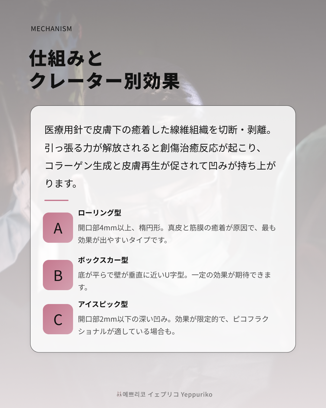 🔍 クレーターのタイプ別 向き・不向き