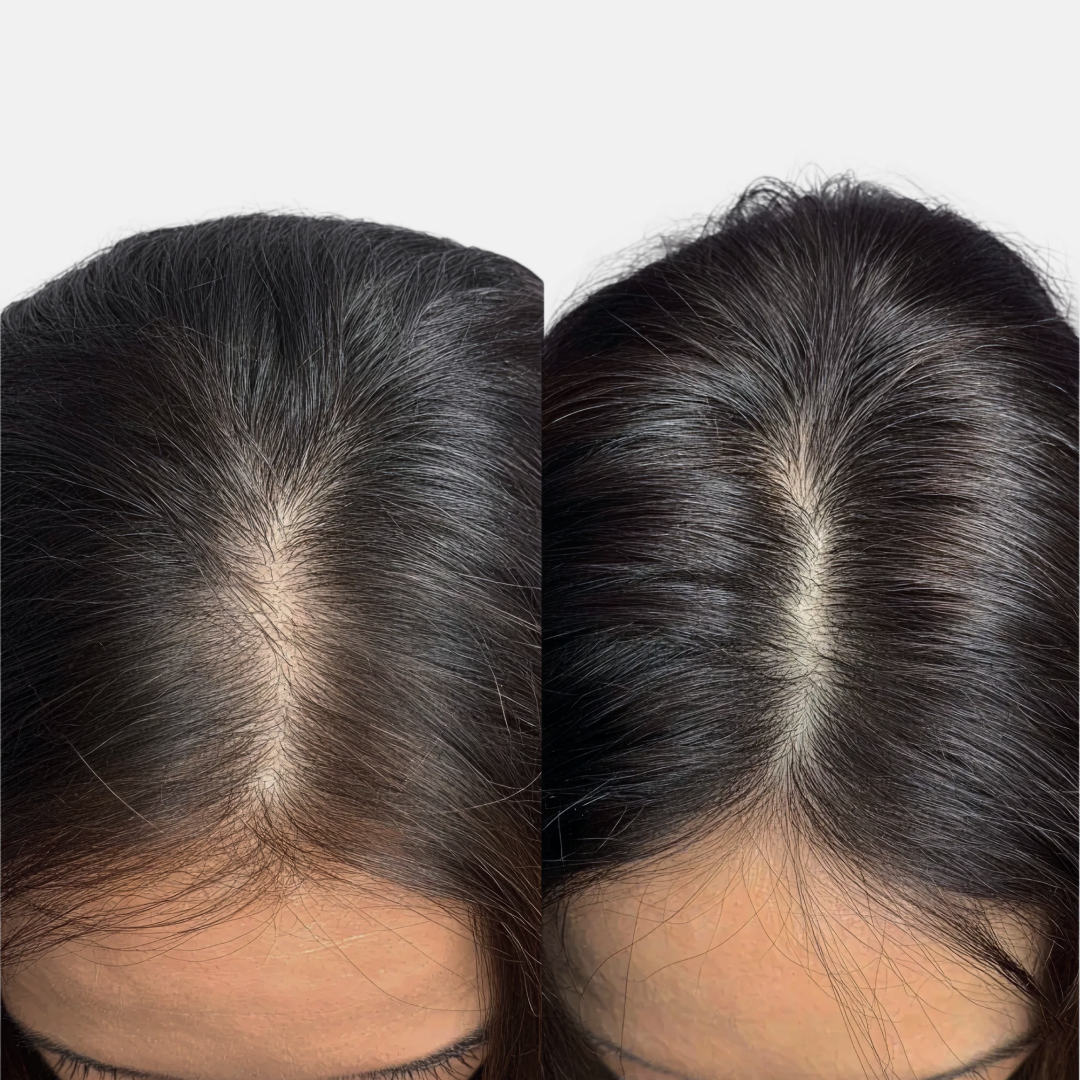 頭皮アートメイク SMP とは？｜薄毛を自然にカバーする最