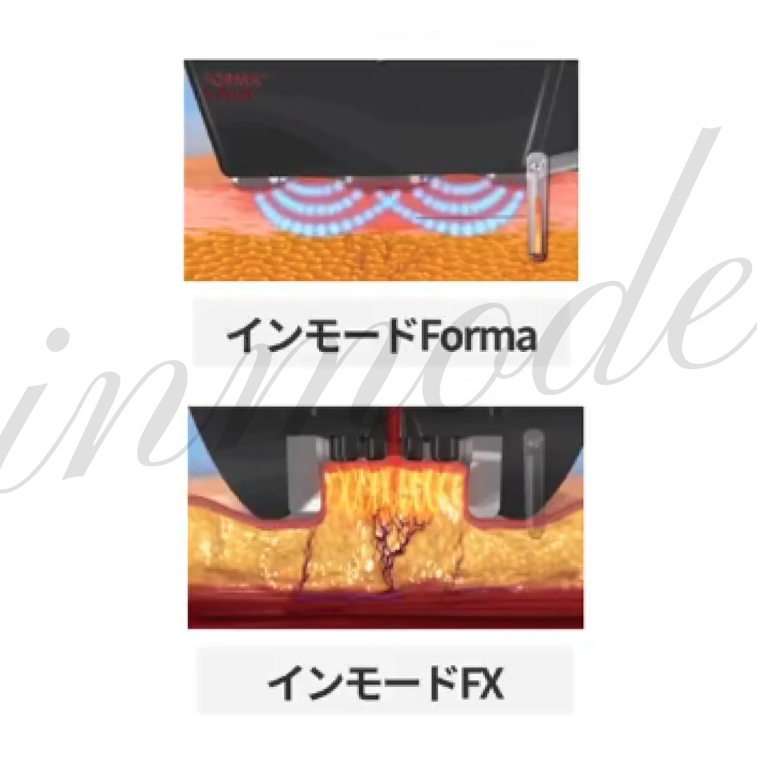 インモード選び、間違ってませんか？｜FXとFormaの違い