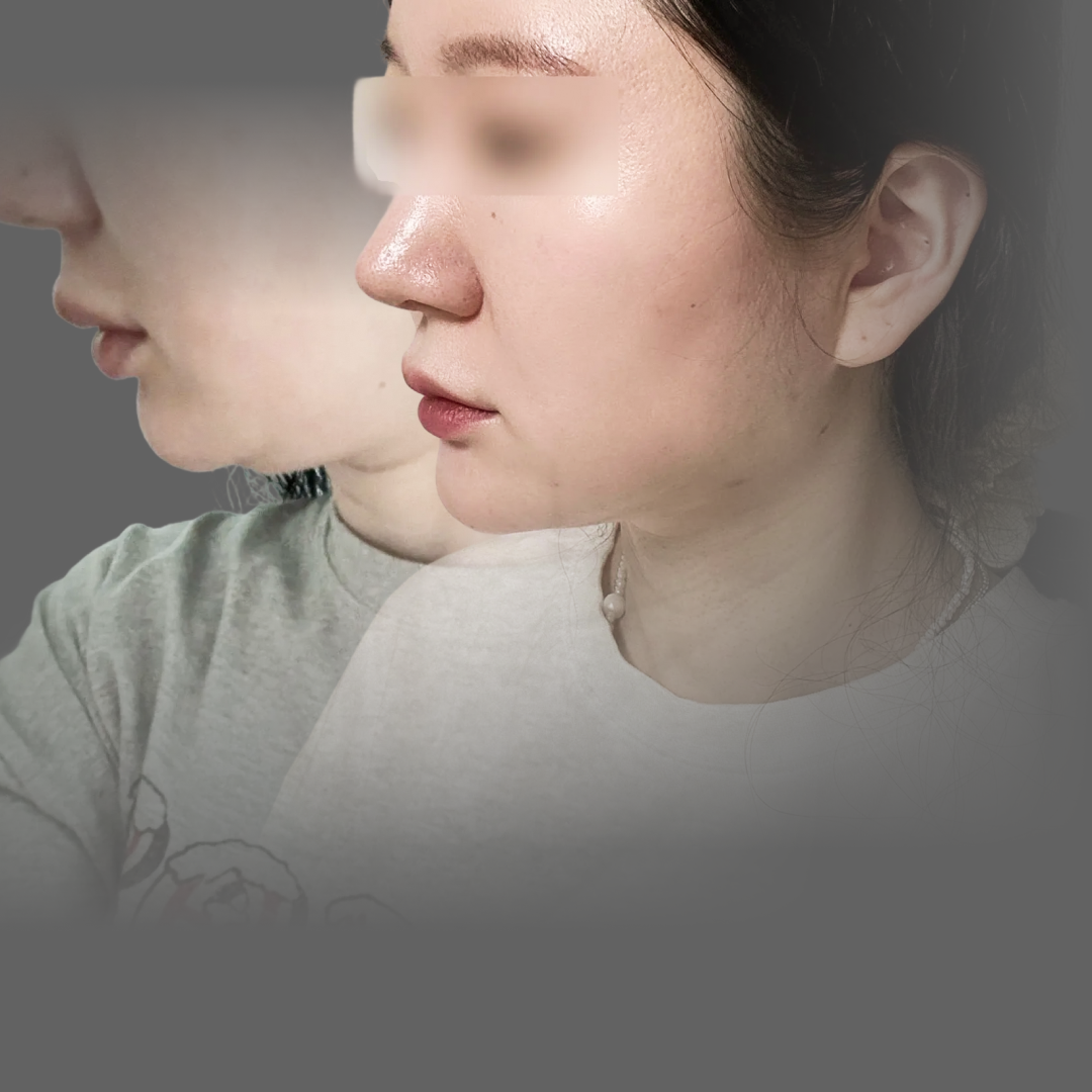 ペリカン手術完全ガイド｜二重顎を根本から改善する最新施術