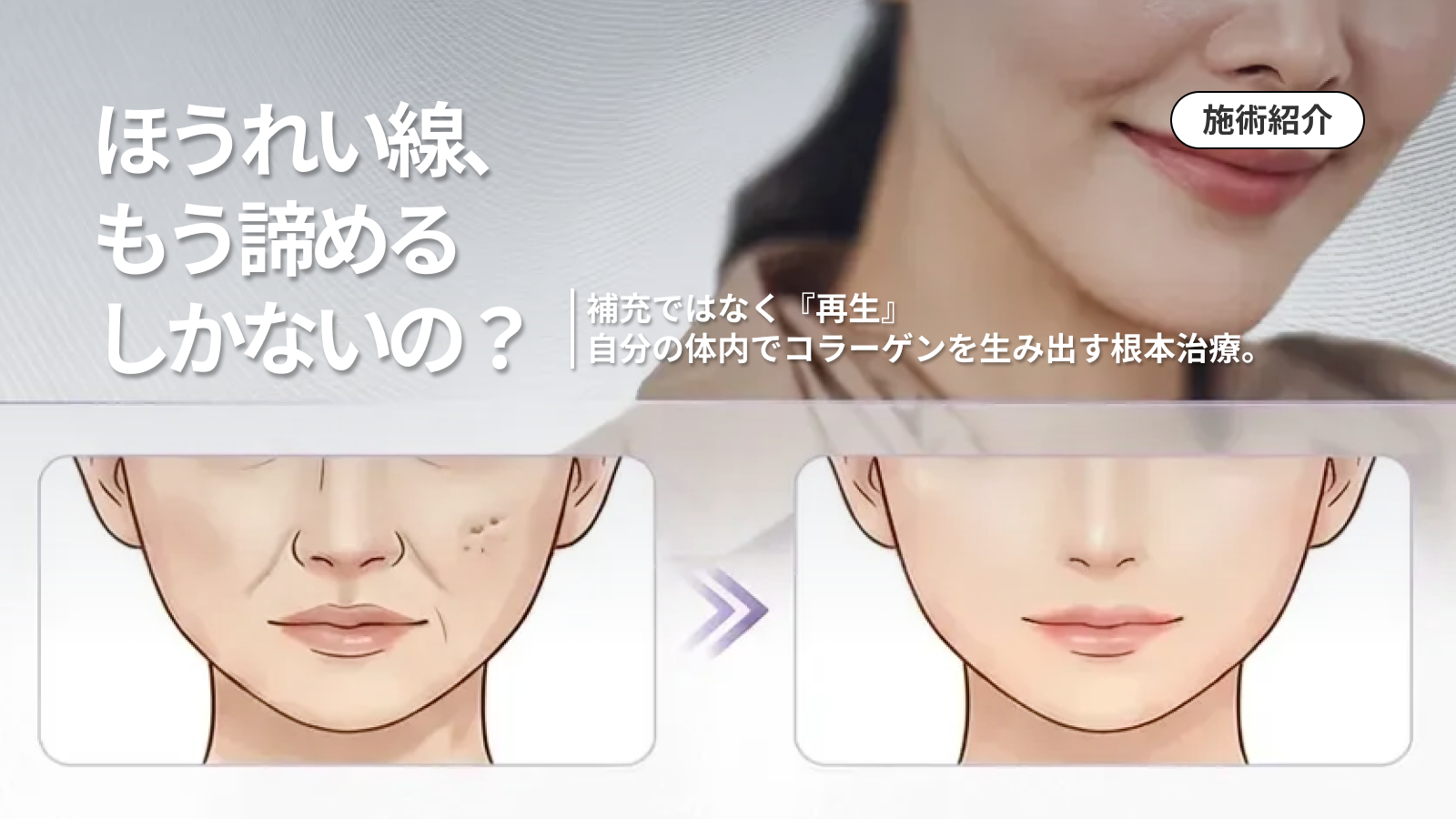 ジュブゼン（JUVGEN）ってどう？“自己真皮再生”の前に